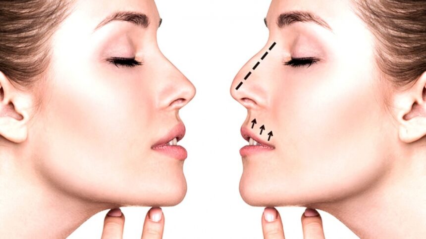 Rinoplastide Cerrahi Teknikler Rinoplastide Cerrahi Teknikler