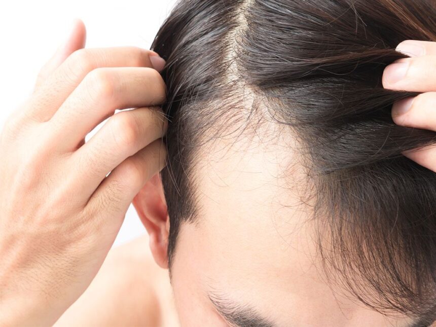 Saç Ekimi Nasıl Yapılır? Saç Ekimi Nasıl Yapılır?